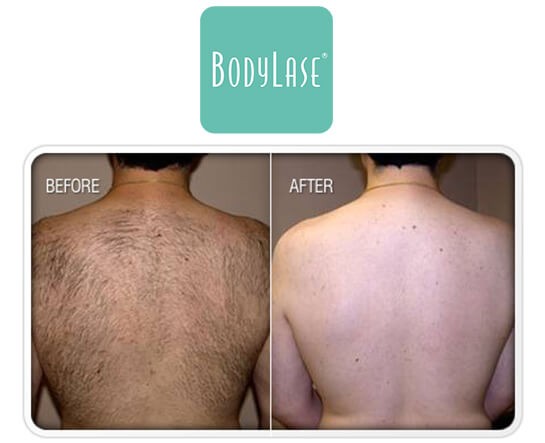 Laser Hair Removal in Raleigh, NC and Cary, NC | BodyLase®